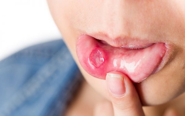 Lở miệng gây nên nhiều đau đớn khi ăn uống, sinh hoạt hàng ngày.